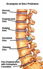 Swimmer's Shoulder 