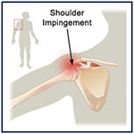 Swimmer's Shoulder 